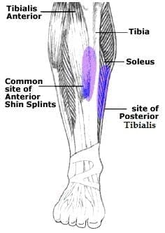 AMR Traveling Ultimate 6 Kit, Episode 3: Shin Splints • Another Mother ...