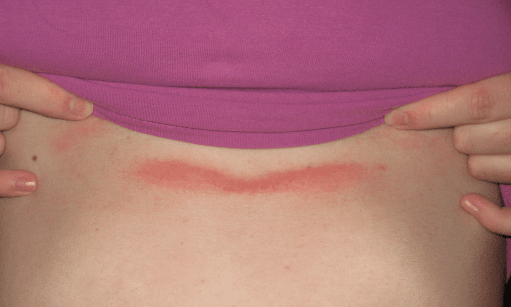How do I prevent my chafing?! I'm always in pain in the summer. :  r/helpmecope